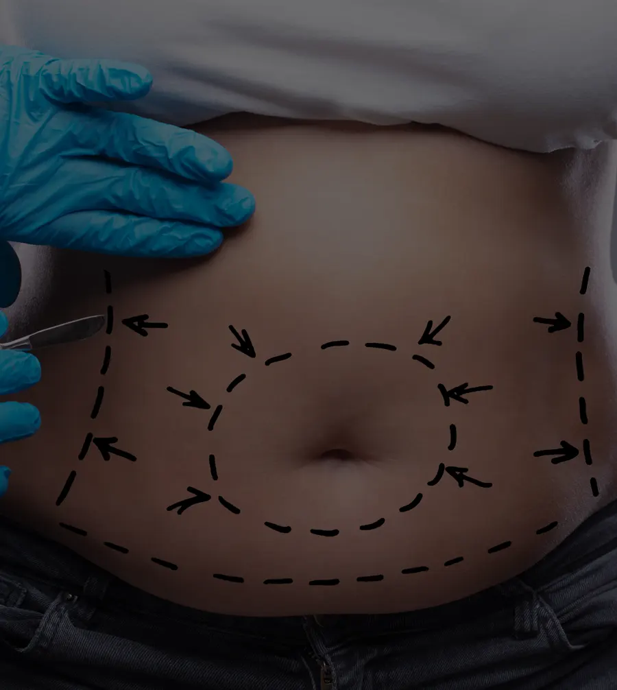Liposuccion