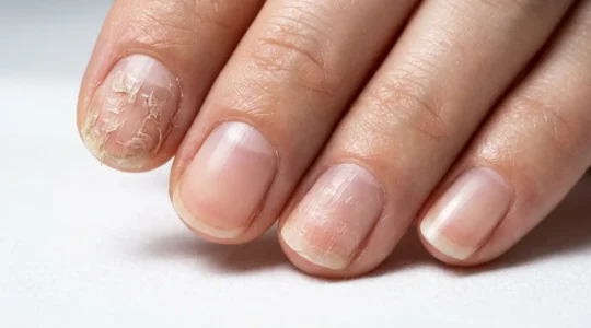 Dettaglio ravvicinato di mani con unghie curate che mostrano la differenza tra unghie sane e danneggiate