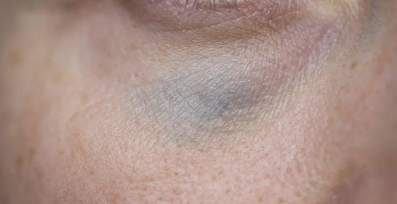 Visualizzazione dell'effetto Tyndall dopo iniezione superficiale di filler sotto gli occhi